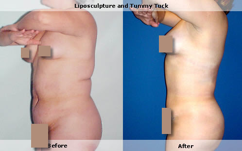 Liposuction, upper body and thighs